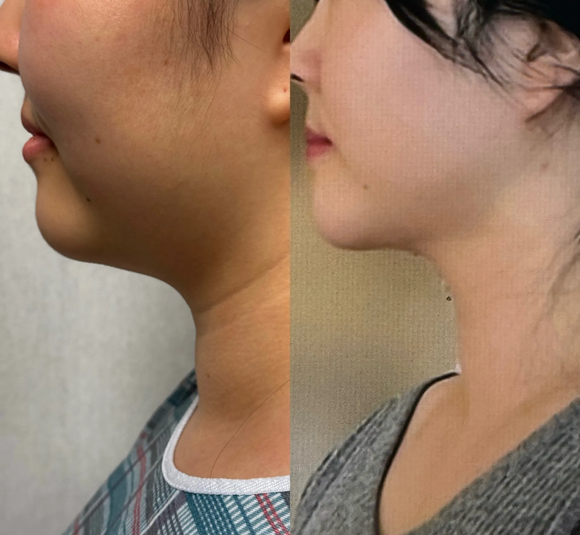Chin & Neck before & after — case 66