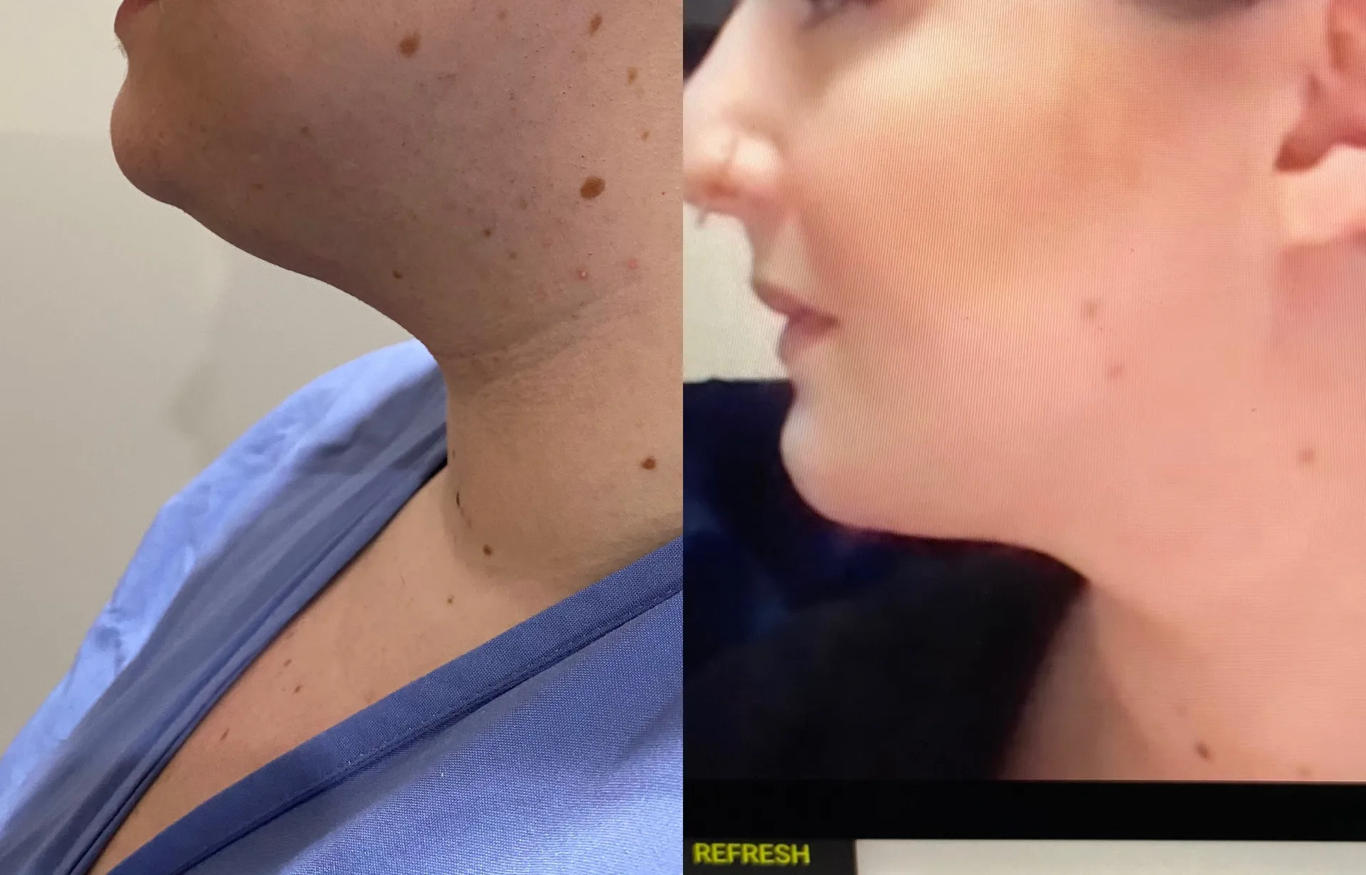 Chin & Neck before & after — case 68