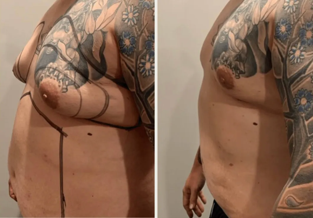 Sides & Flanks before & after — case 83