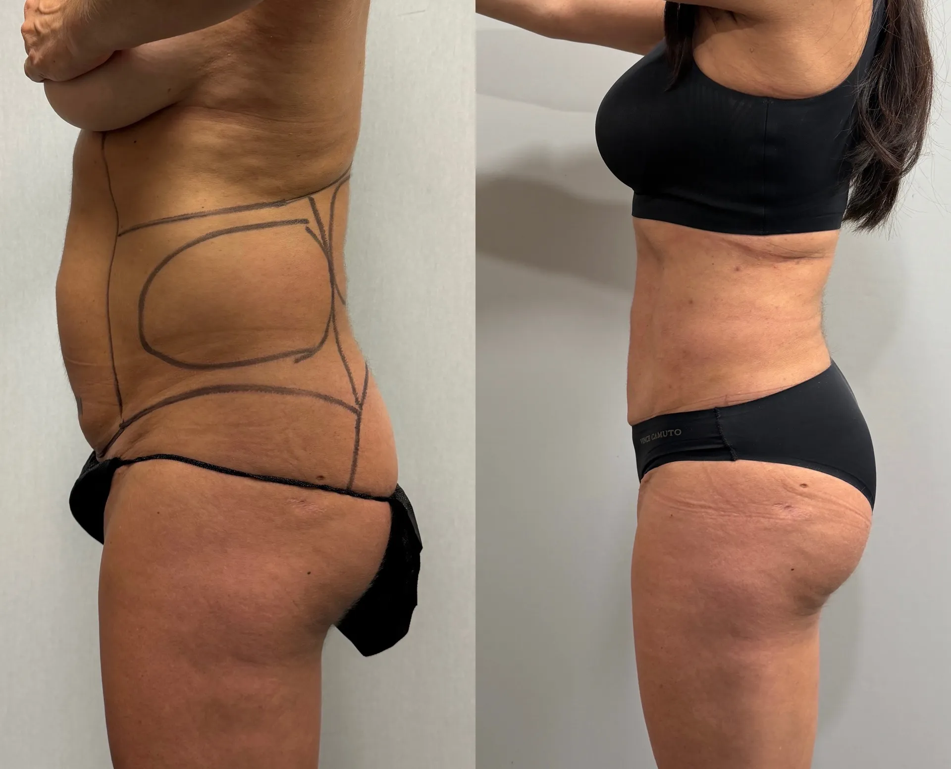 Sides & Flanks before & after — case 75