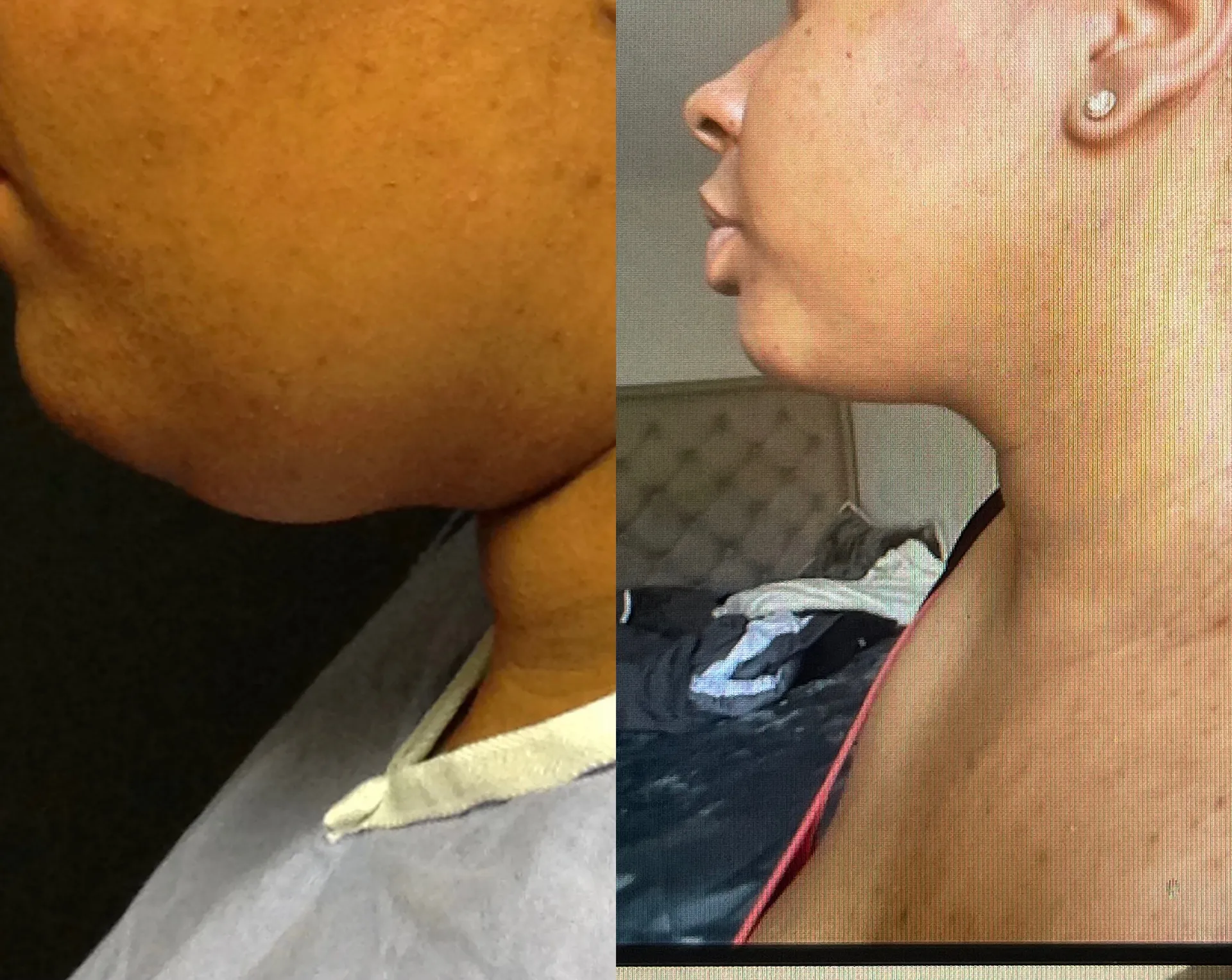 Chin & Neck before & after — case 67