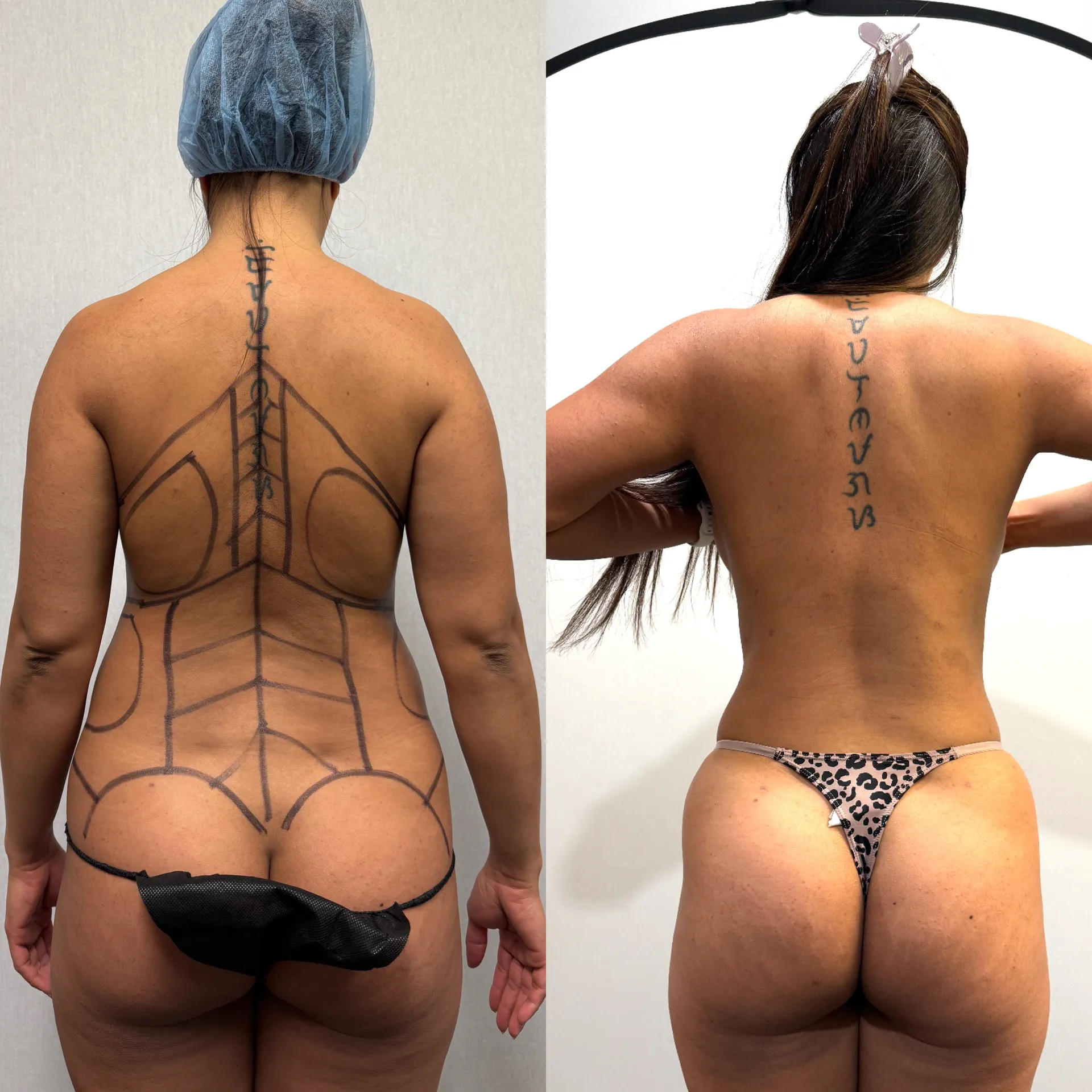 Back before & after — case 16