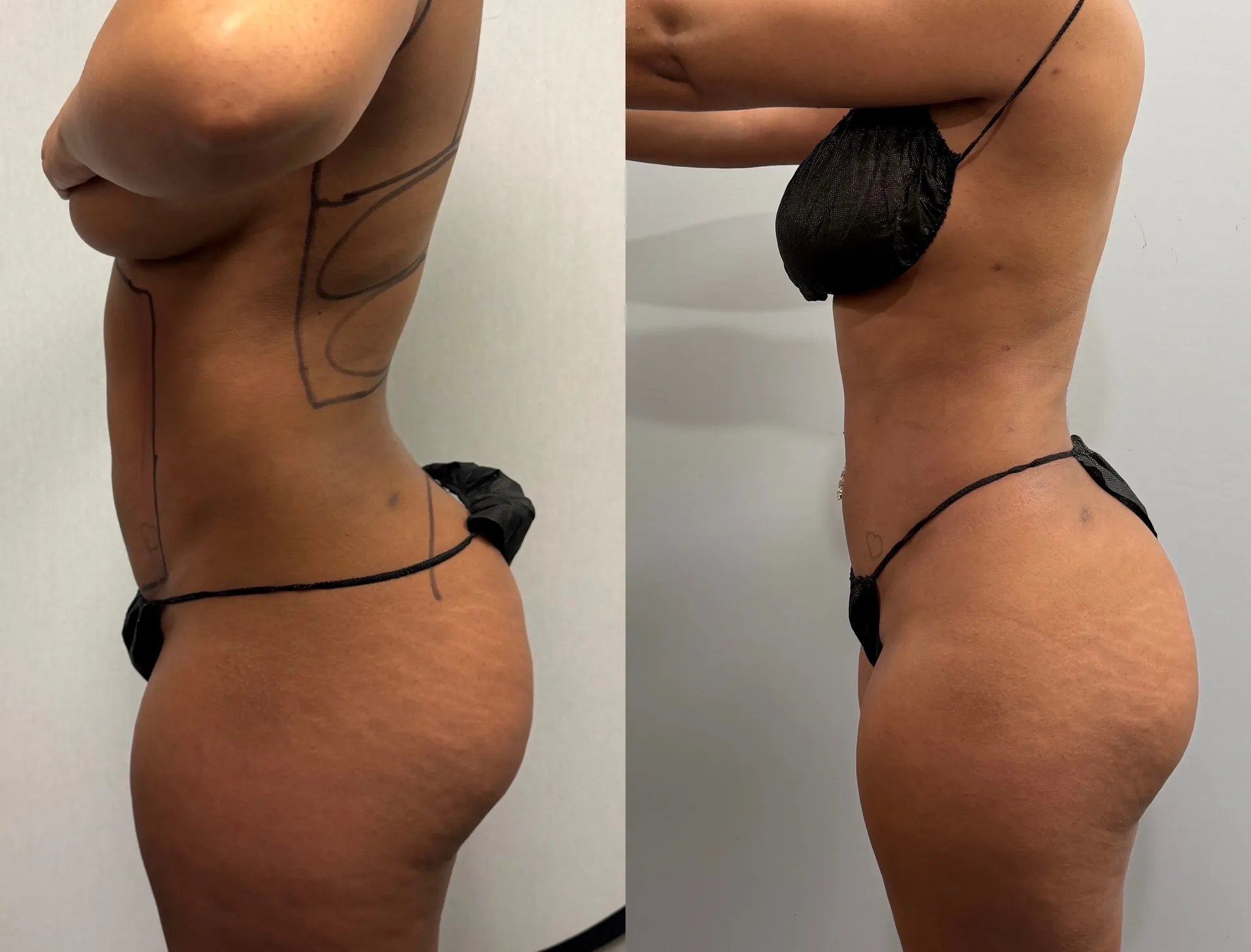 Sides & Flanks before & after — case 74
