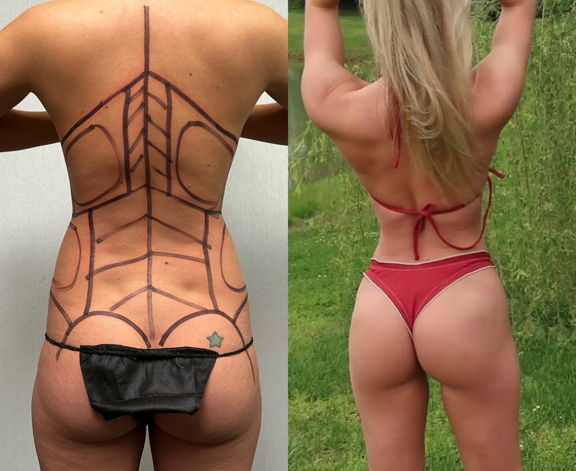 Back before & after — case 14