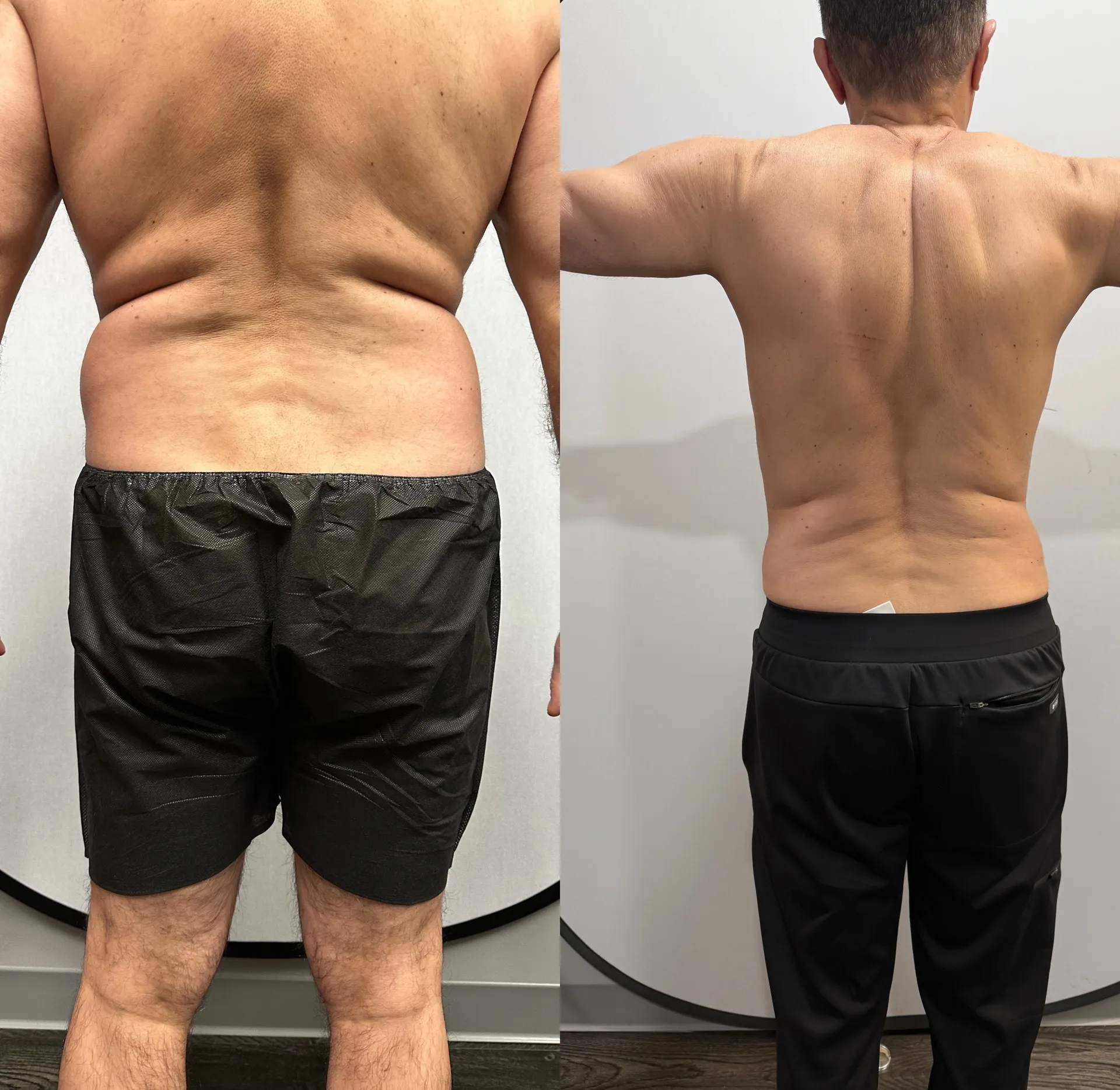Back before & after — case 13