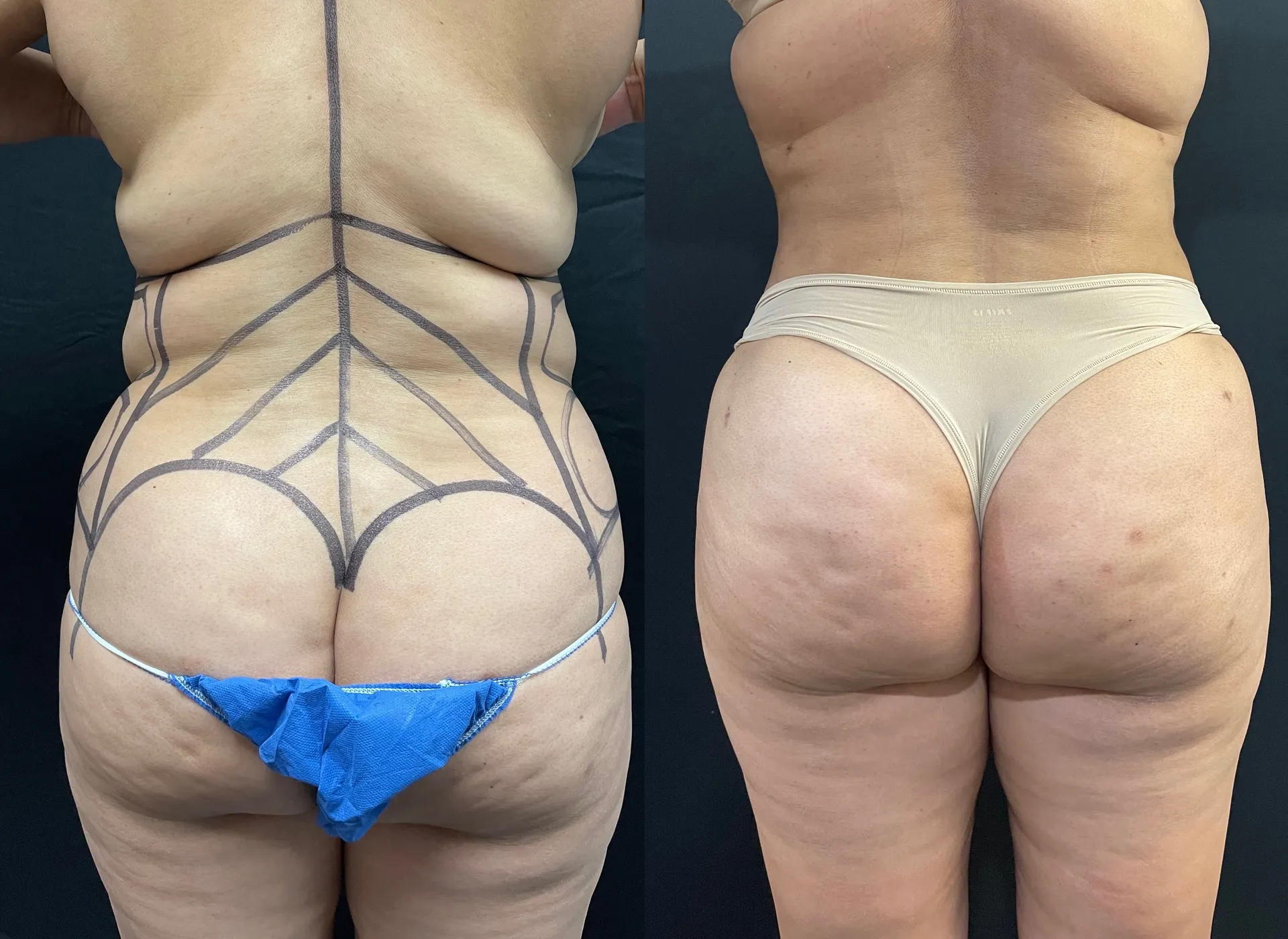 Back before & after — case 12