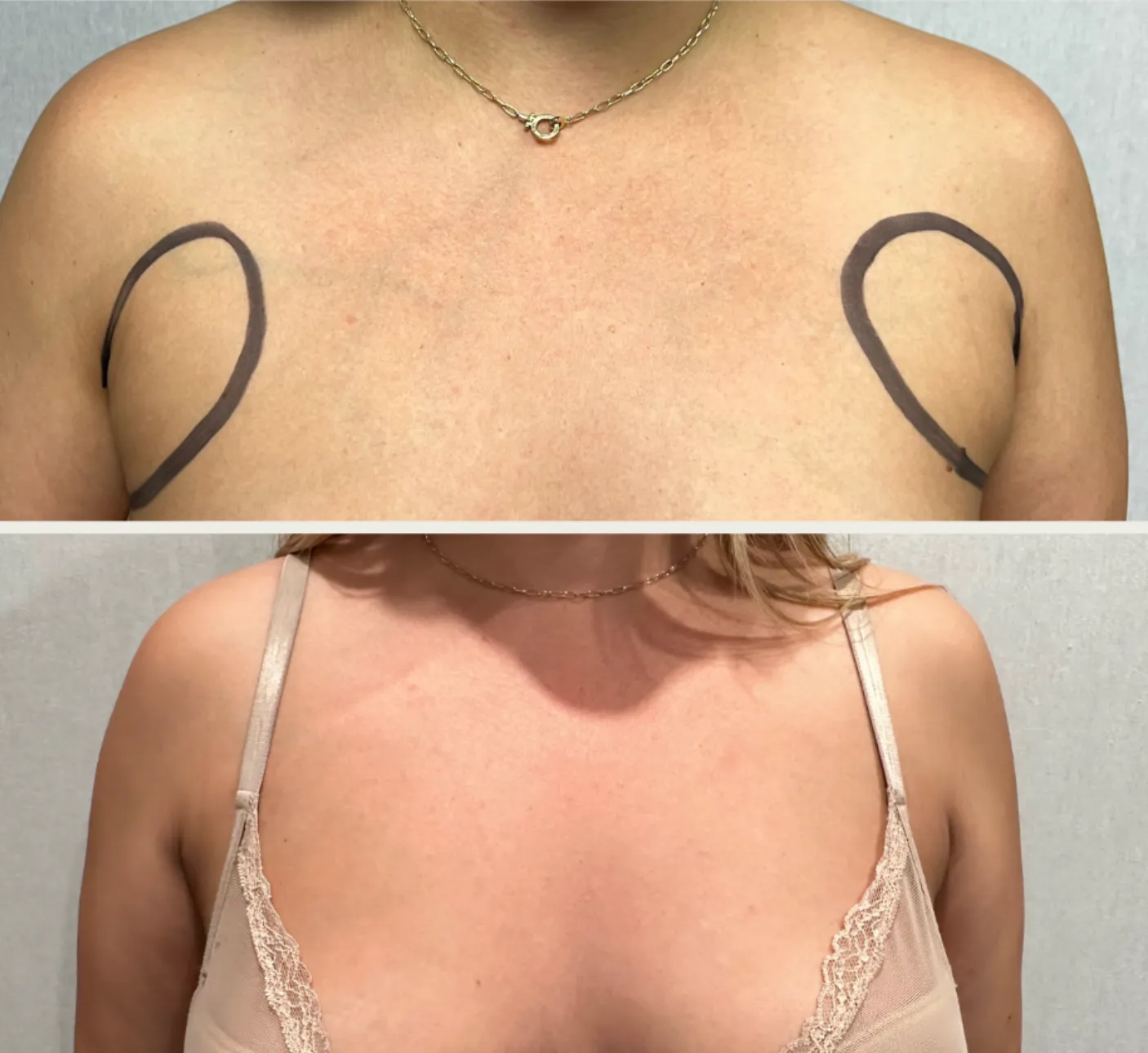 Bra-Line before & after — case 20