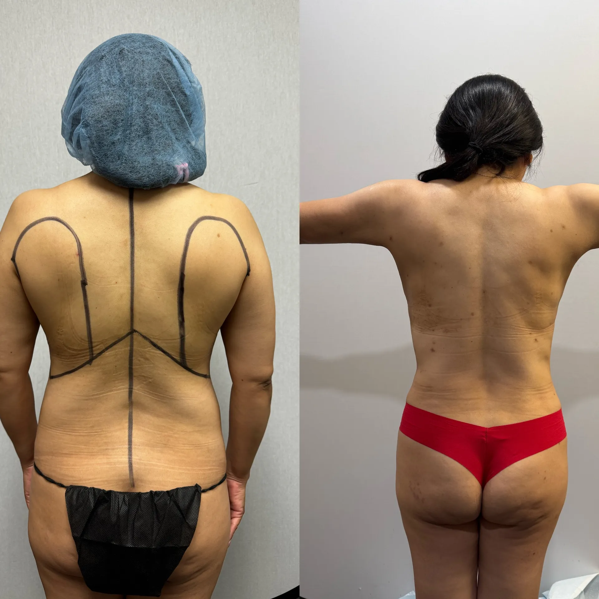 Back before & after — case 15
