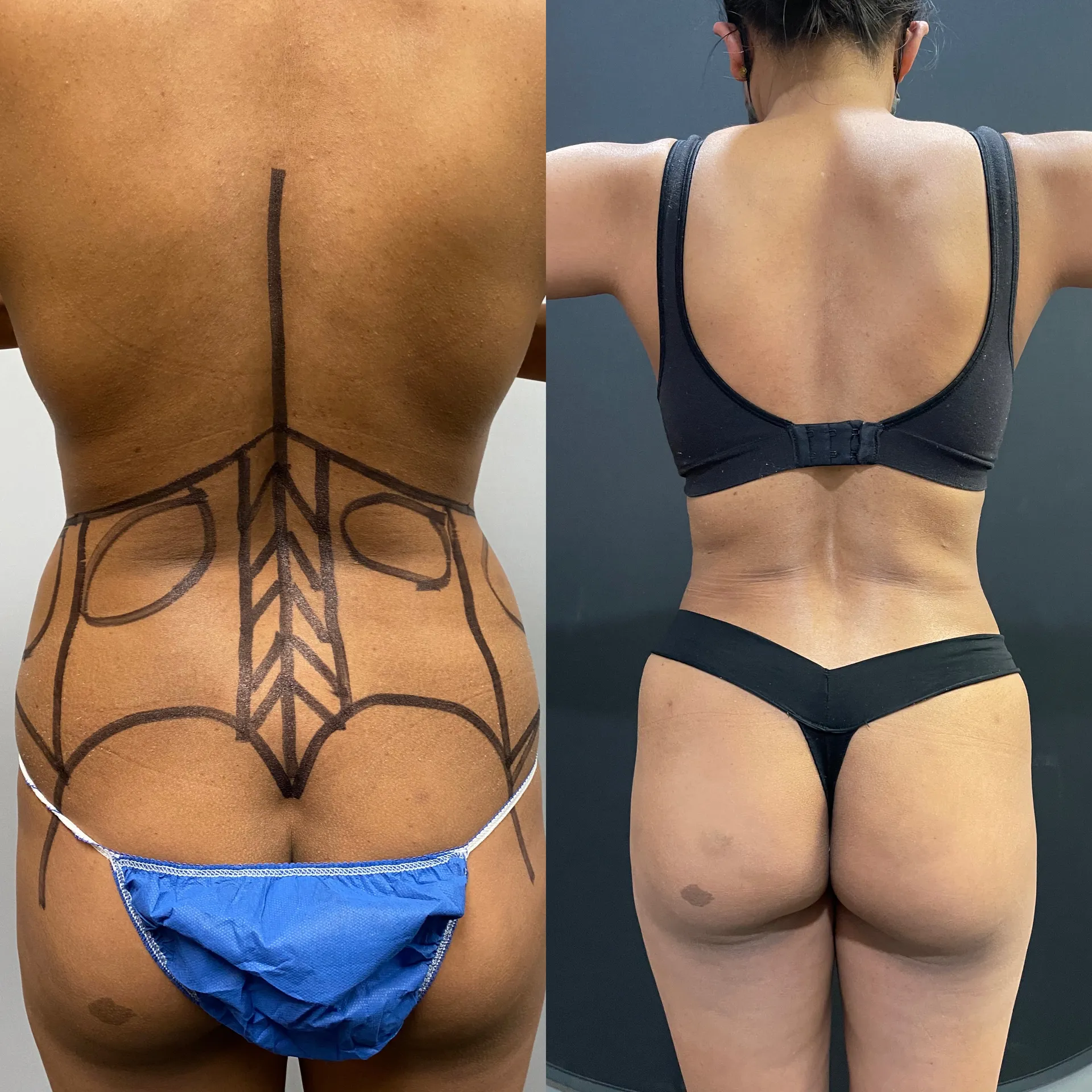 Back before & after — case 08