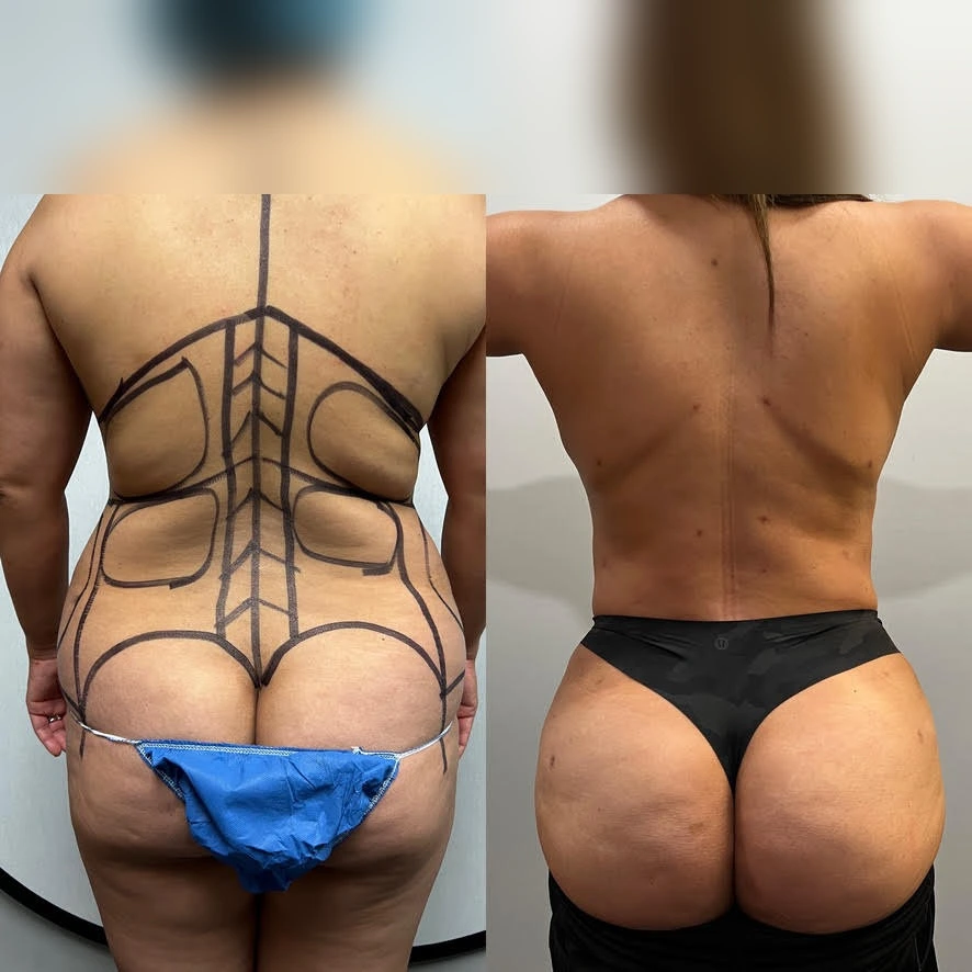 Women — Back