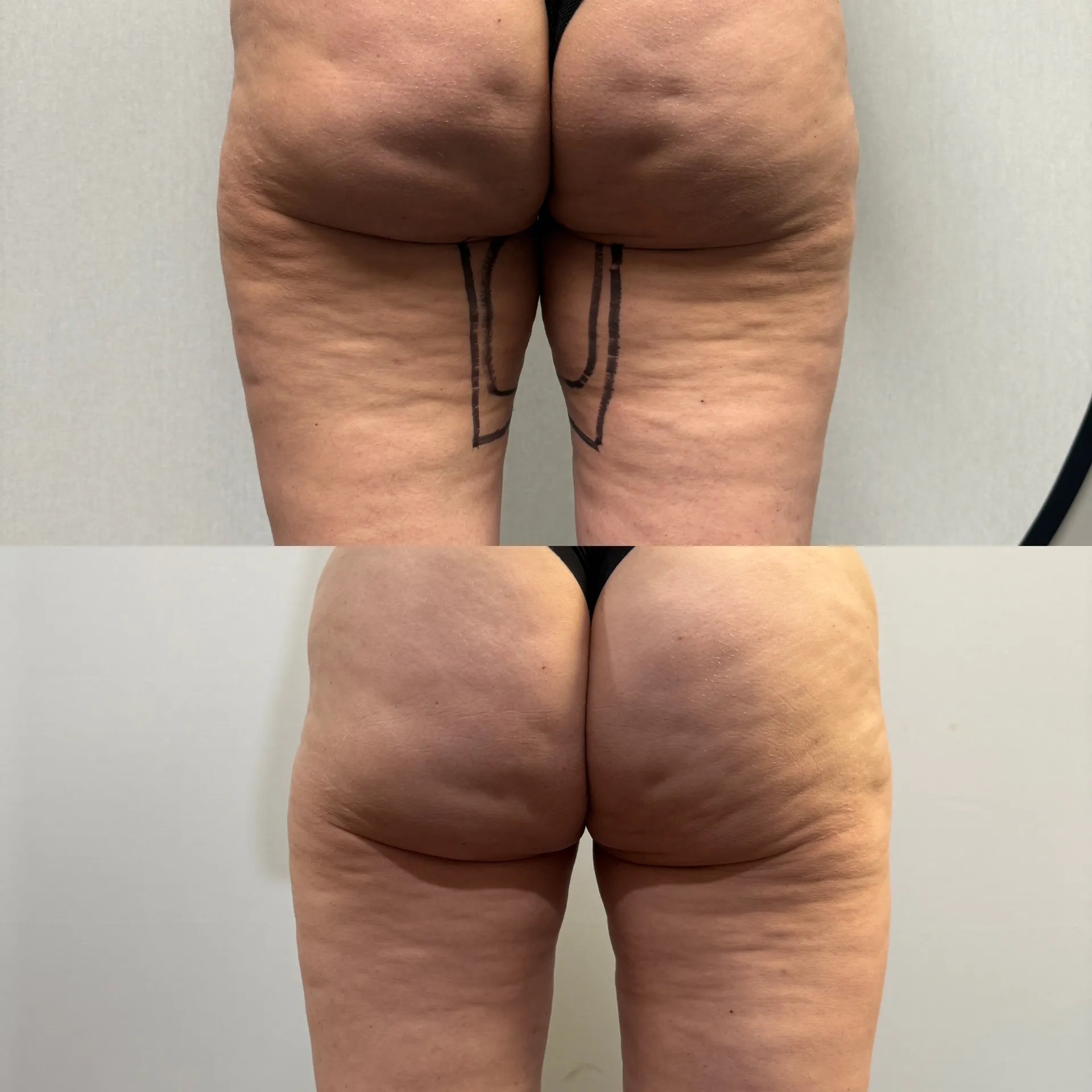 Back before & after — case 18
