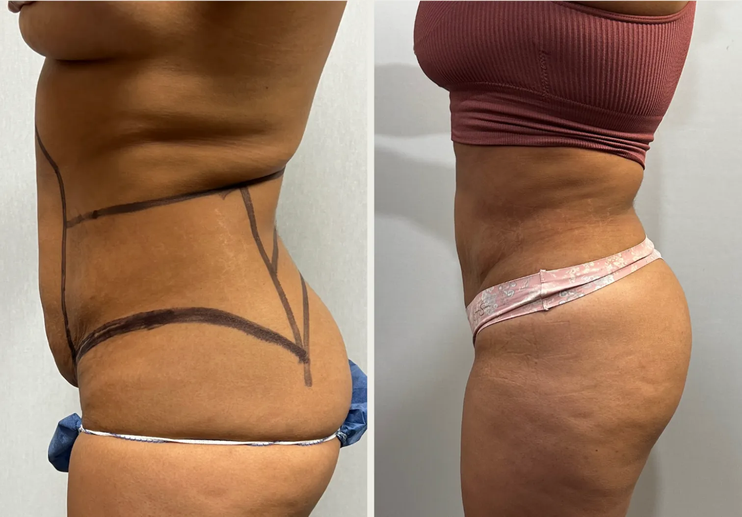 Sides & Flanks before & after — case 81