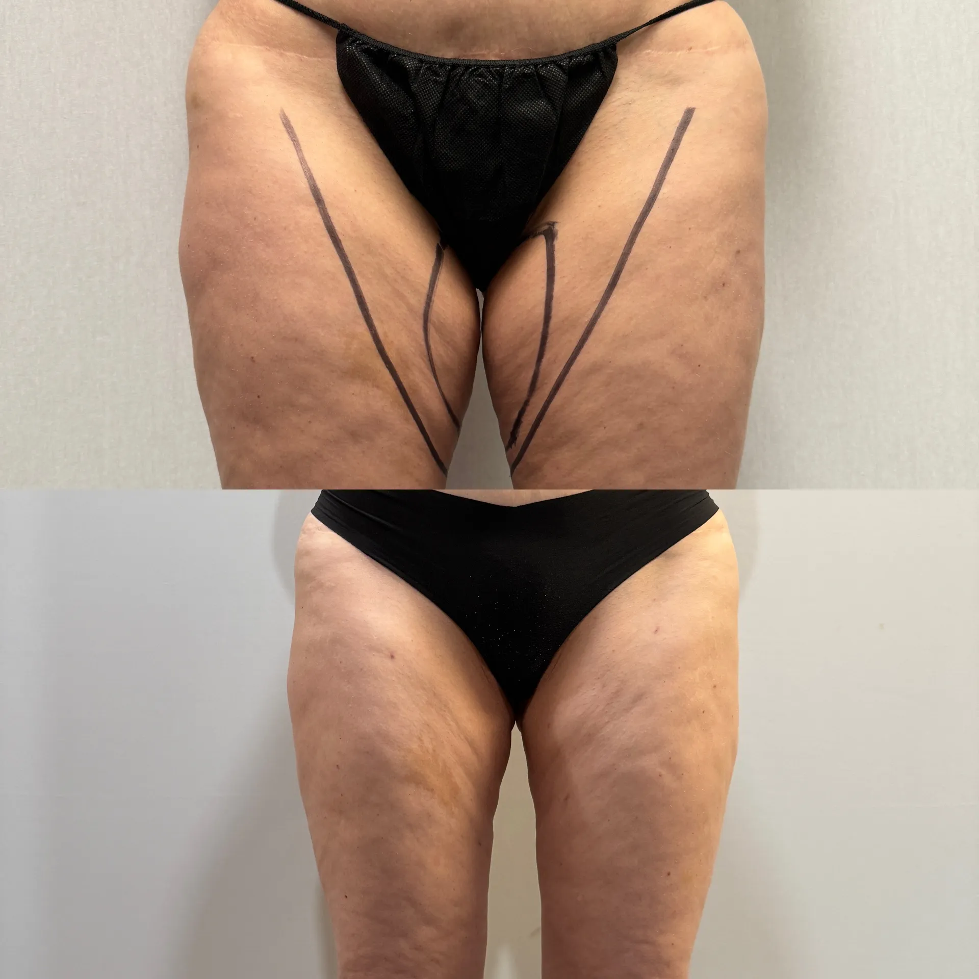 Abdomen before & after — case 32