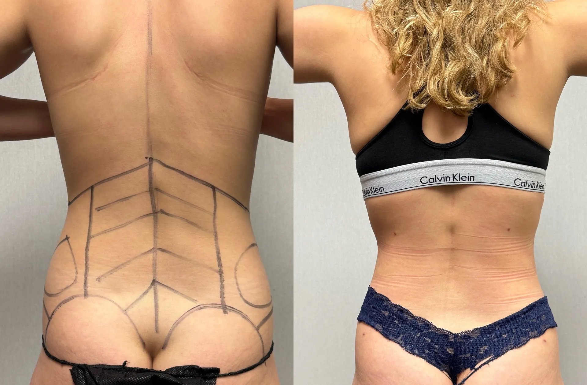 Back before & after — case 17
