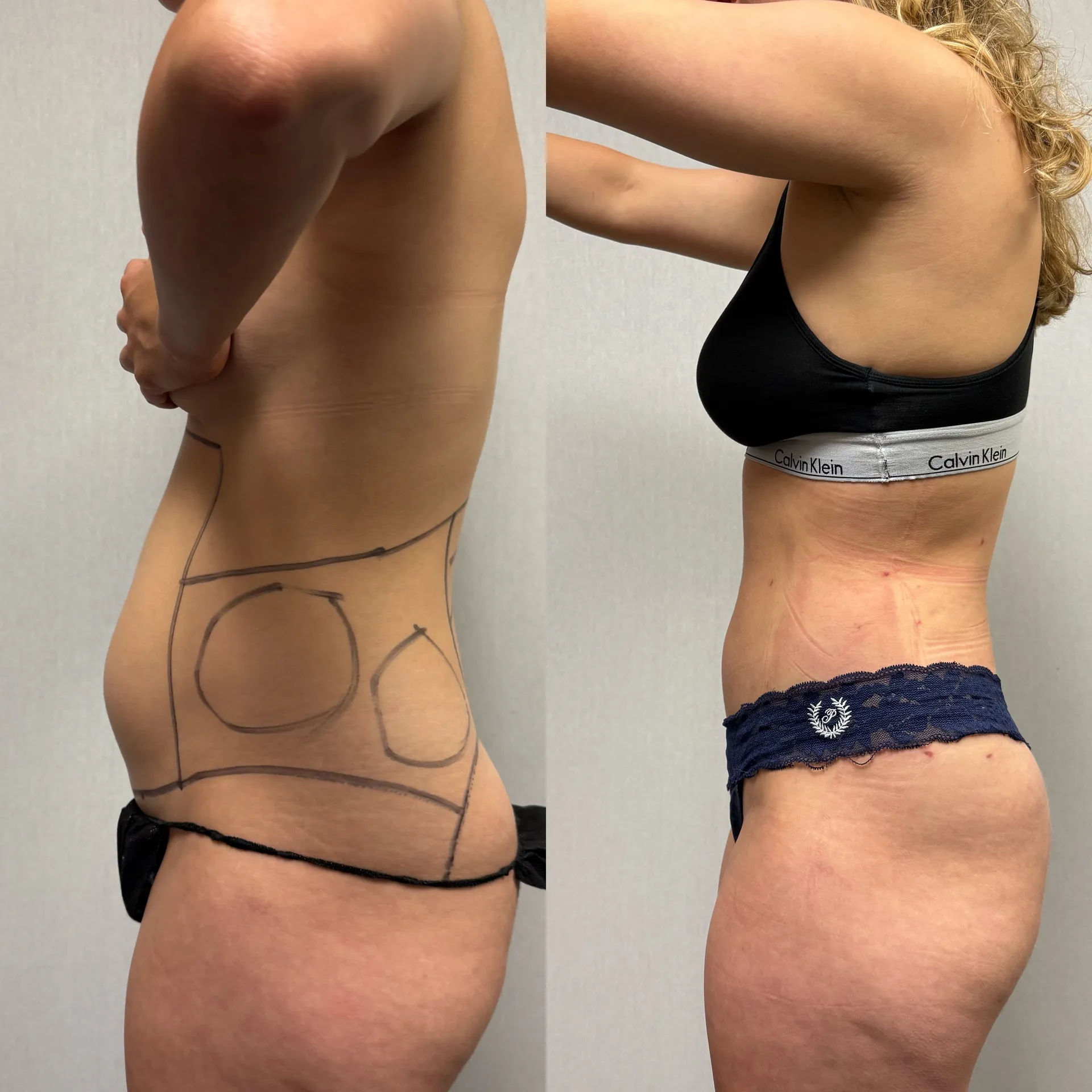 Sides & Flanks before & after — case 76