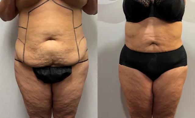 Mini Tummy Tuck before & after — case 55