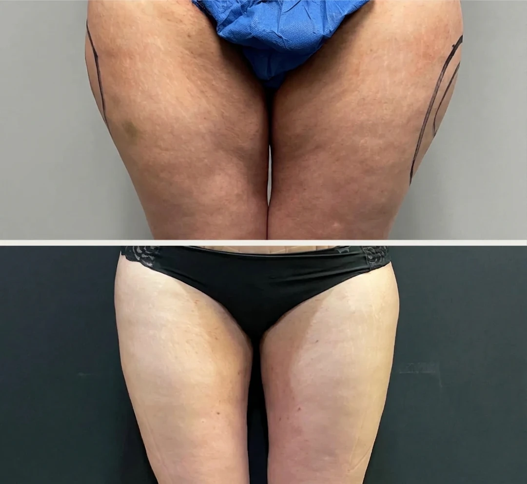 Women — Thighs