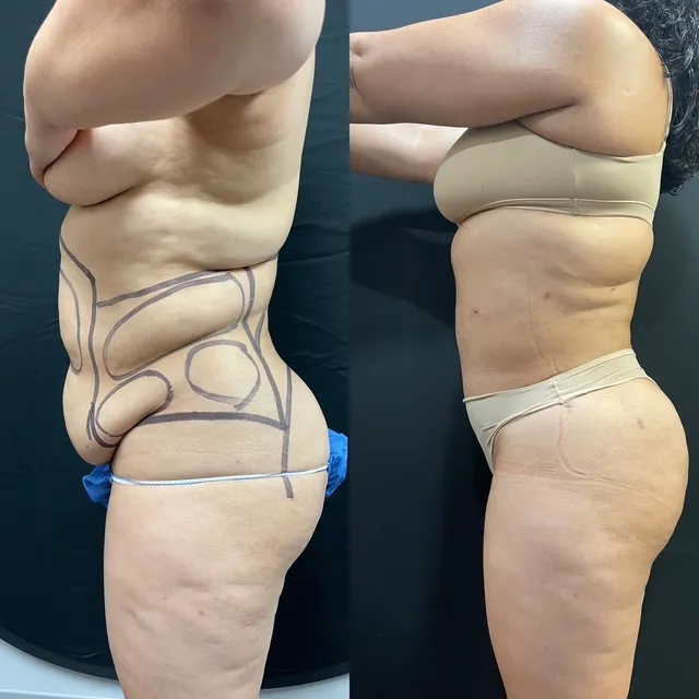 Mini Tummy Tuck before & after — case 62