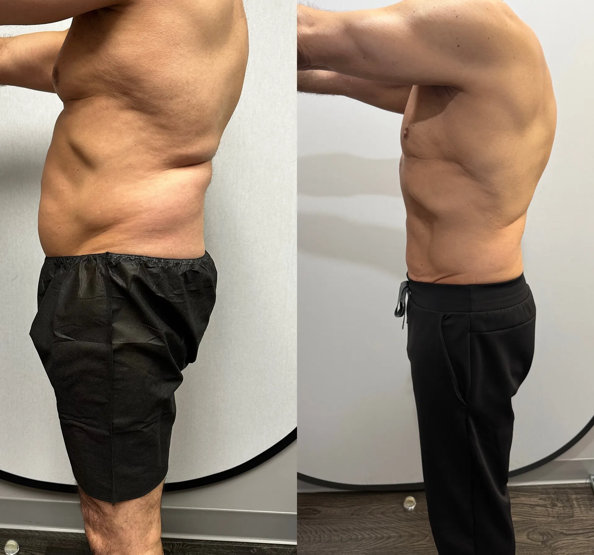 Sides & Flanks before & after — case 78