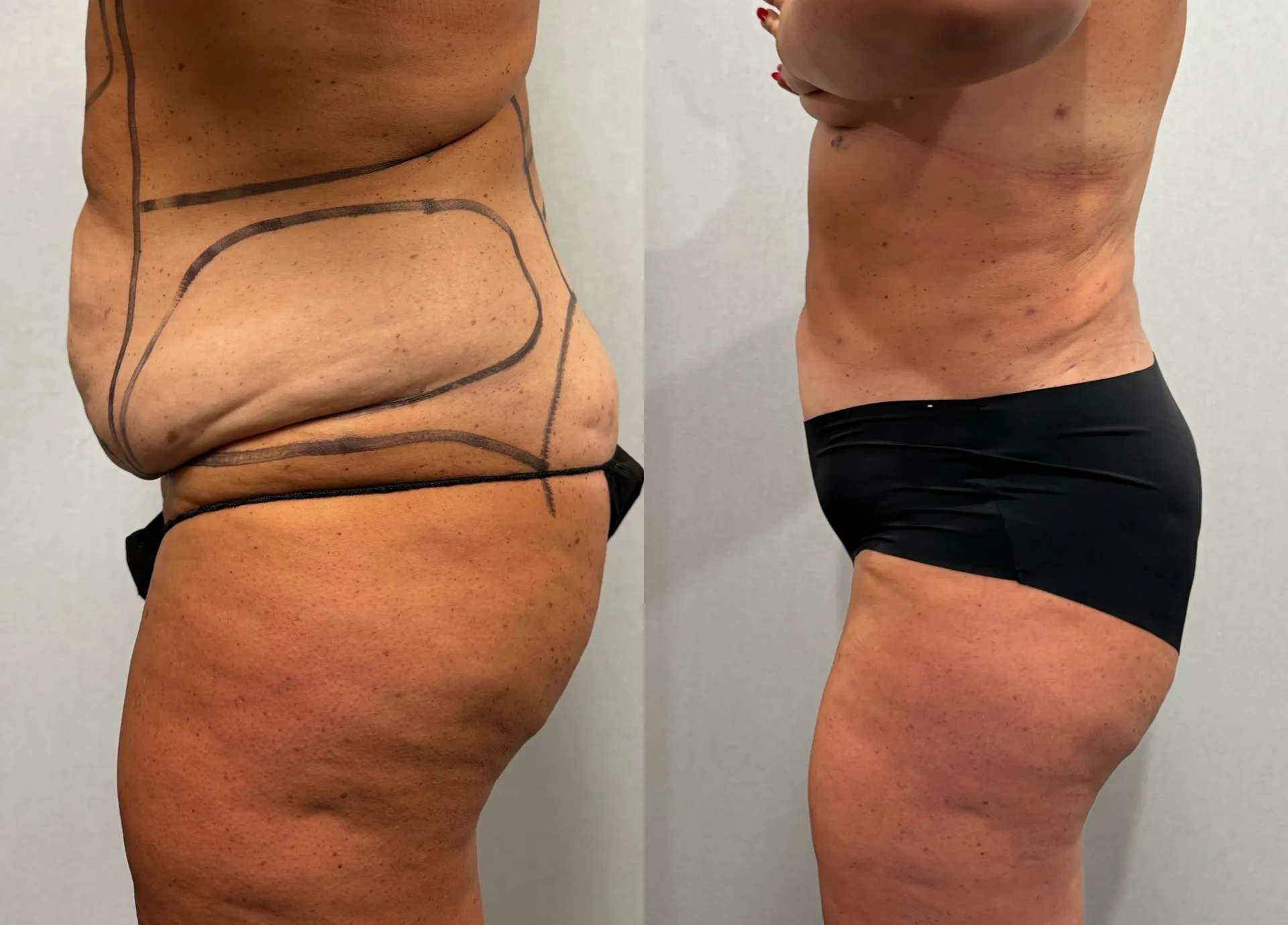 Sides & Flanks before & after — case 86