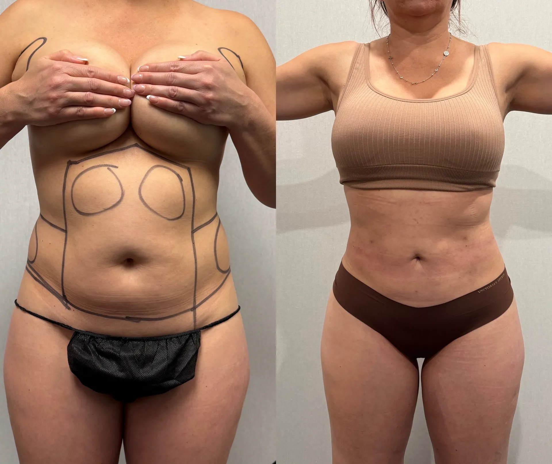 Abdomen before & after — case 33