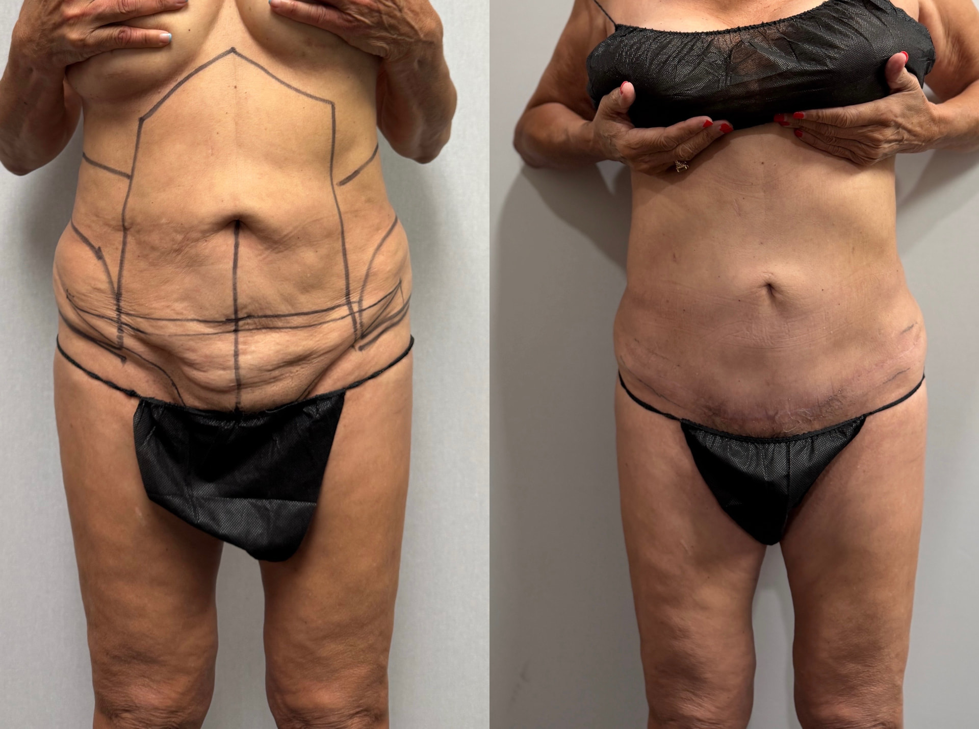 Women — Mini Tummy Tuck