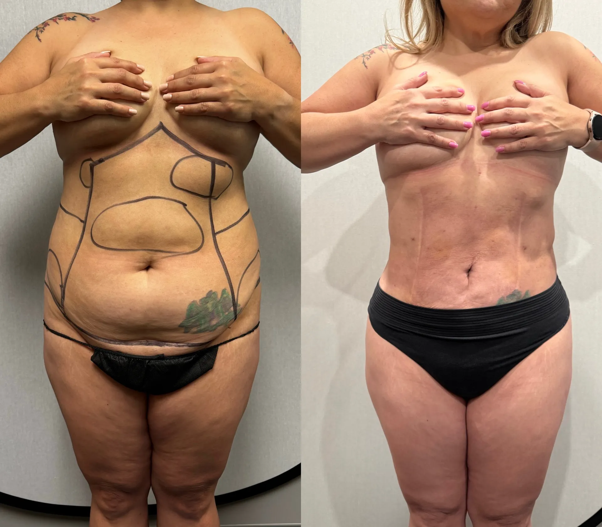 Abdomen before & after — case 28