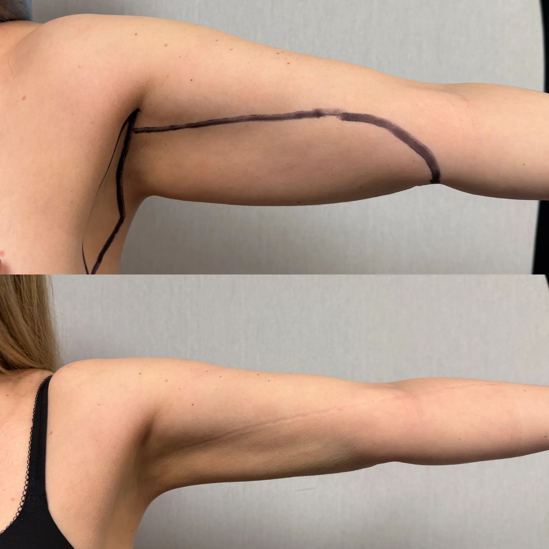 Arms before & after — case 02