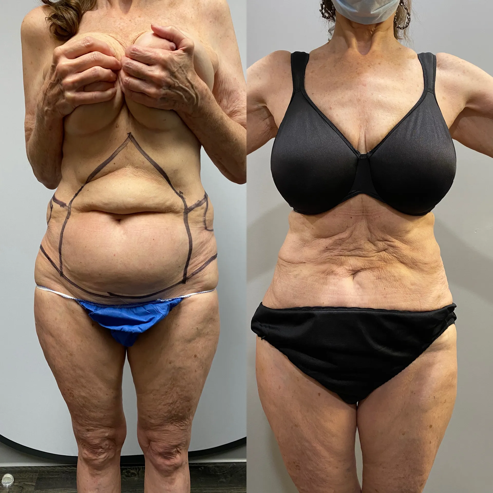 Results before & after — case 46