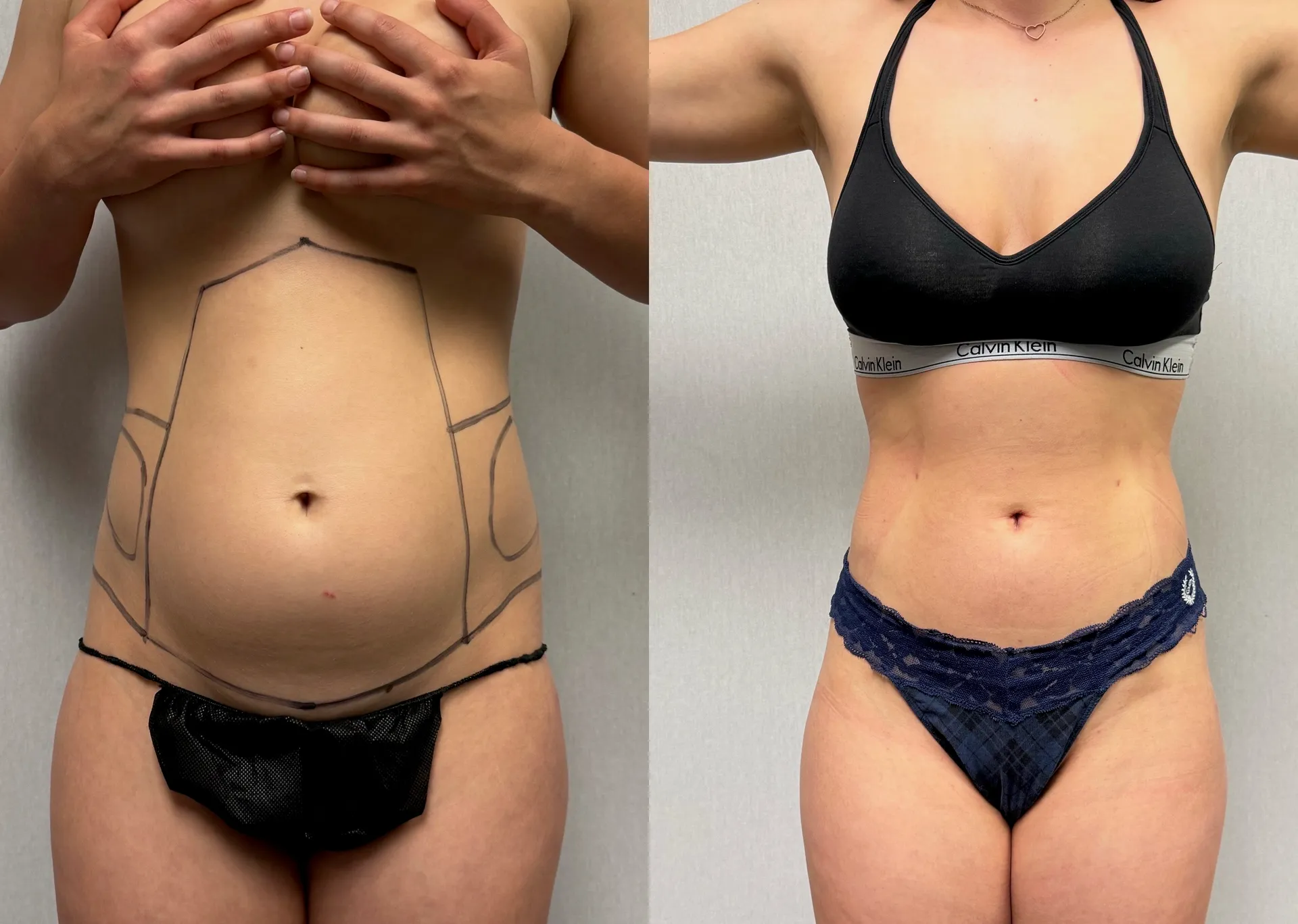 Abdomen before & after — case 31
