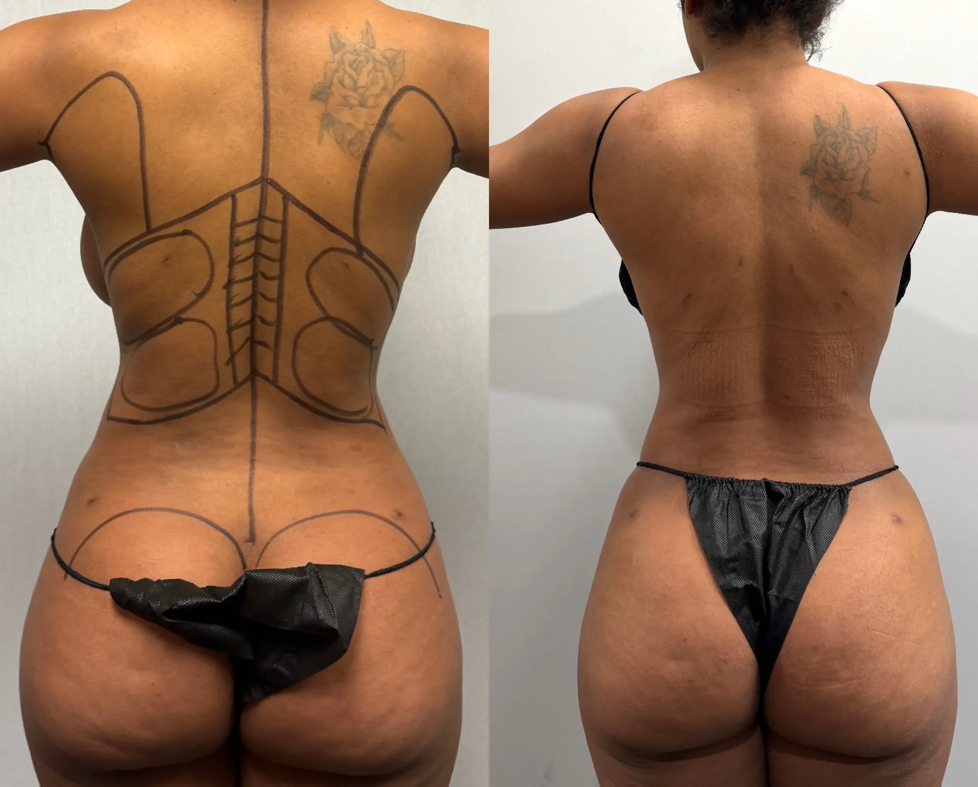 Back before & after — case 07