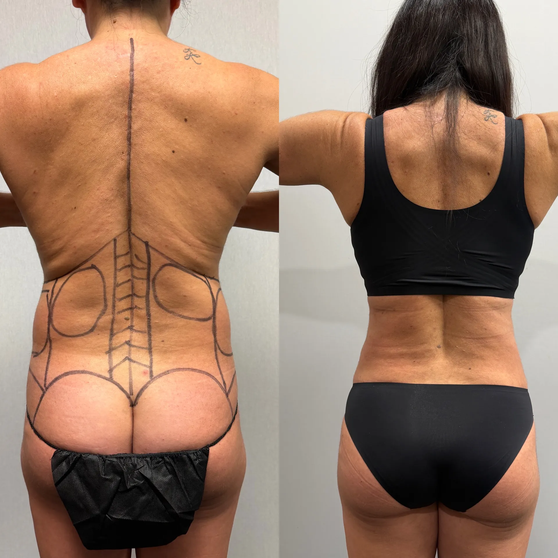 Back before & after — case 09