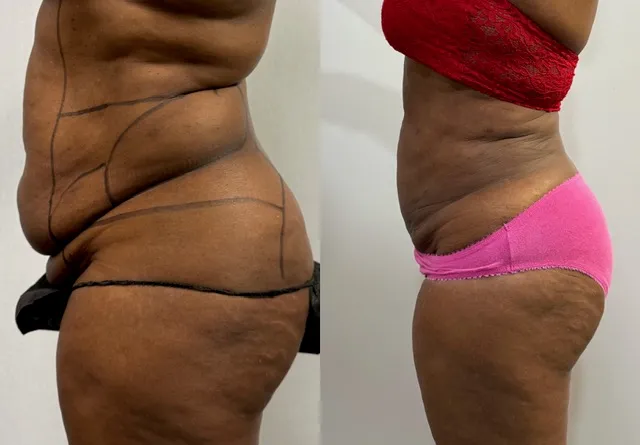 Mini Tummy Tuck before & after — case 64