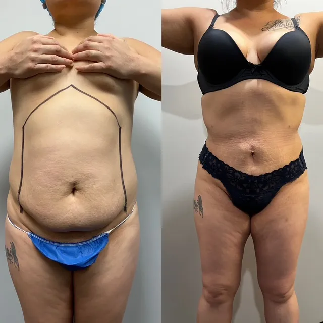 Mini Tummy Tuck before & after — case 52