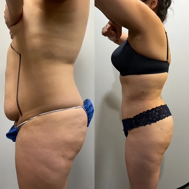 Mini Tummy Tuck before & after — case 63