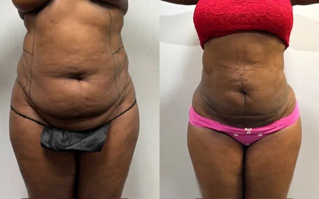 Mini Tummy Tuck before & after — case 54