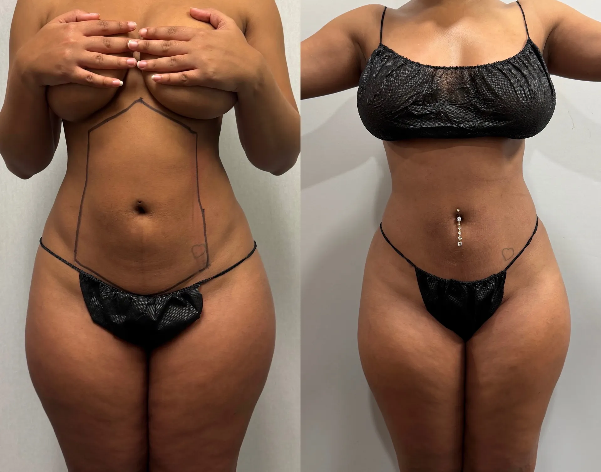 Abdomen before & after — case 22