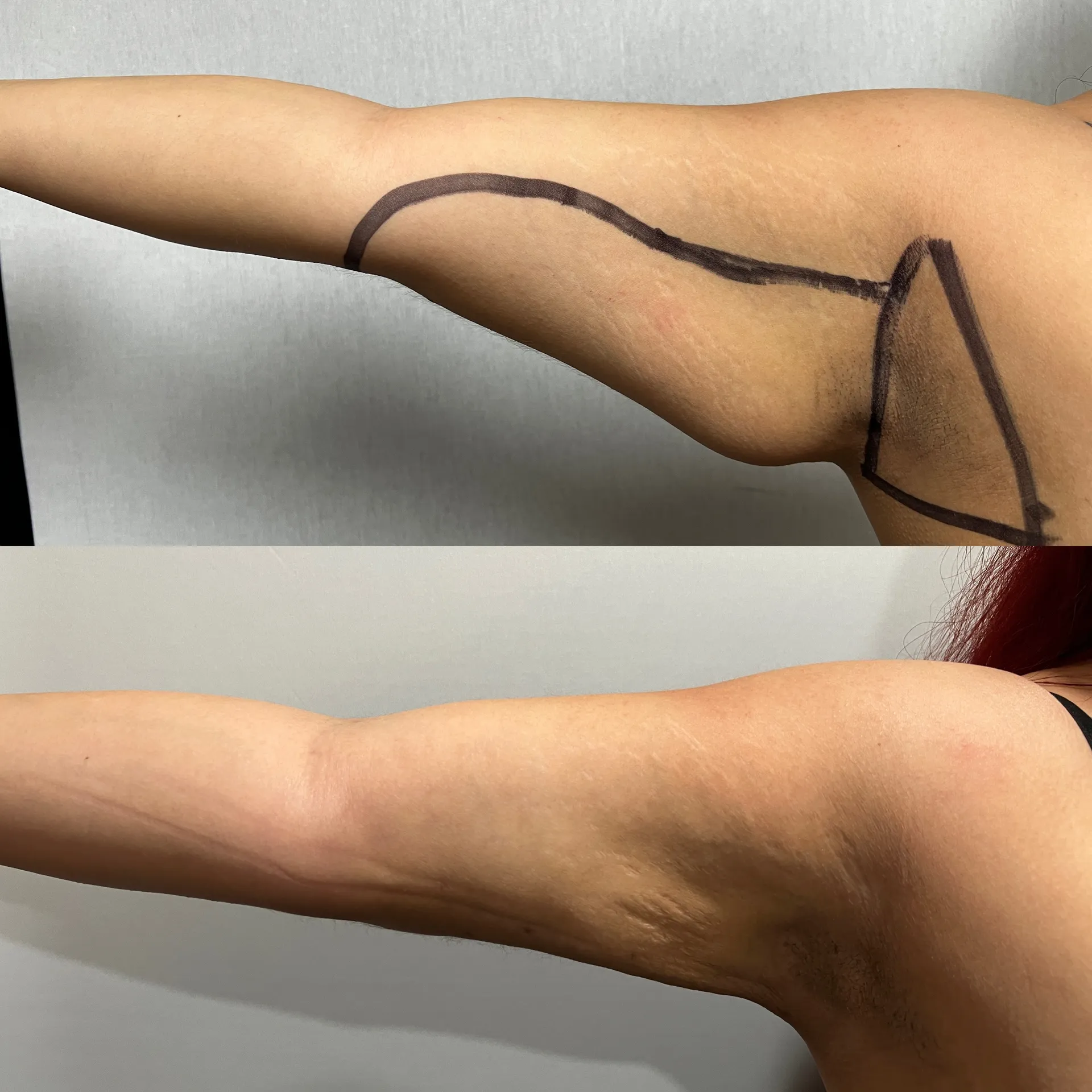 Arms before & after — case 03