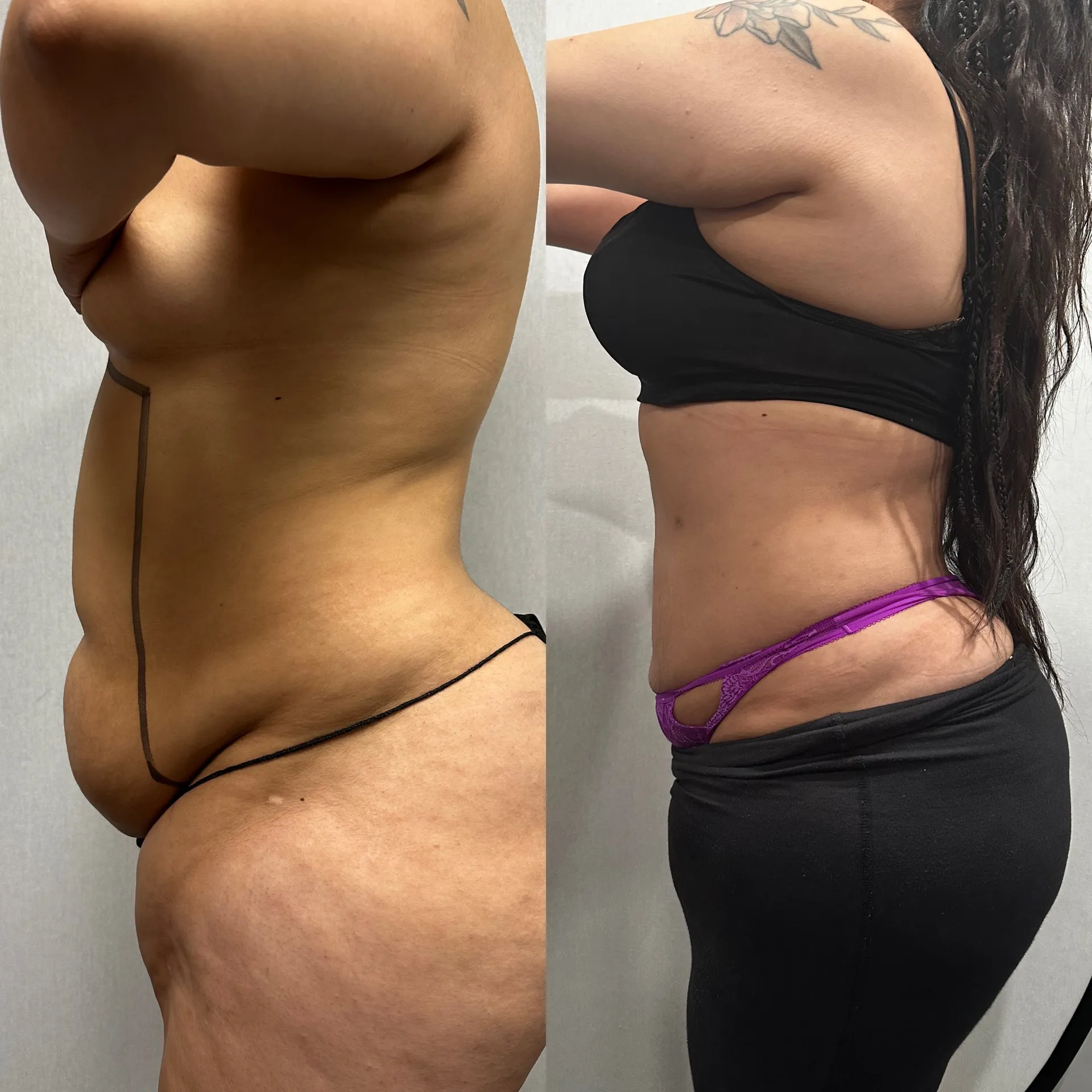 Sides & Flanks before & after — case 73