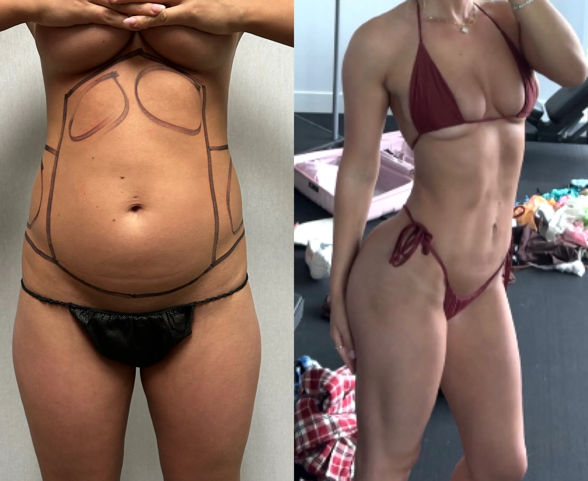 Abdomen before & after — case 29
