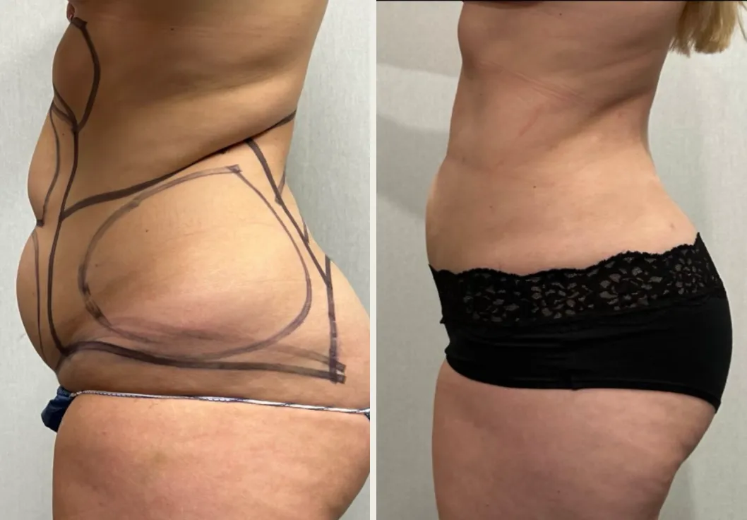 Sides & Flanks before & after — case 82
