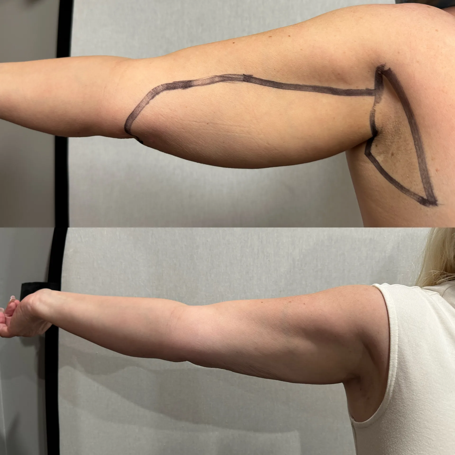 Arms before & after — case 06