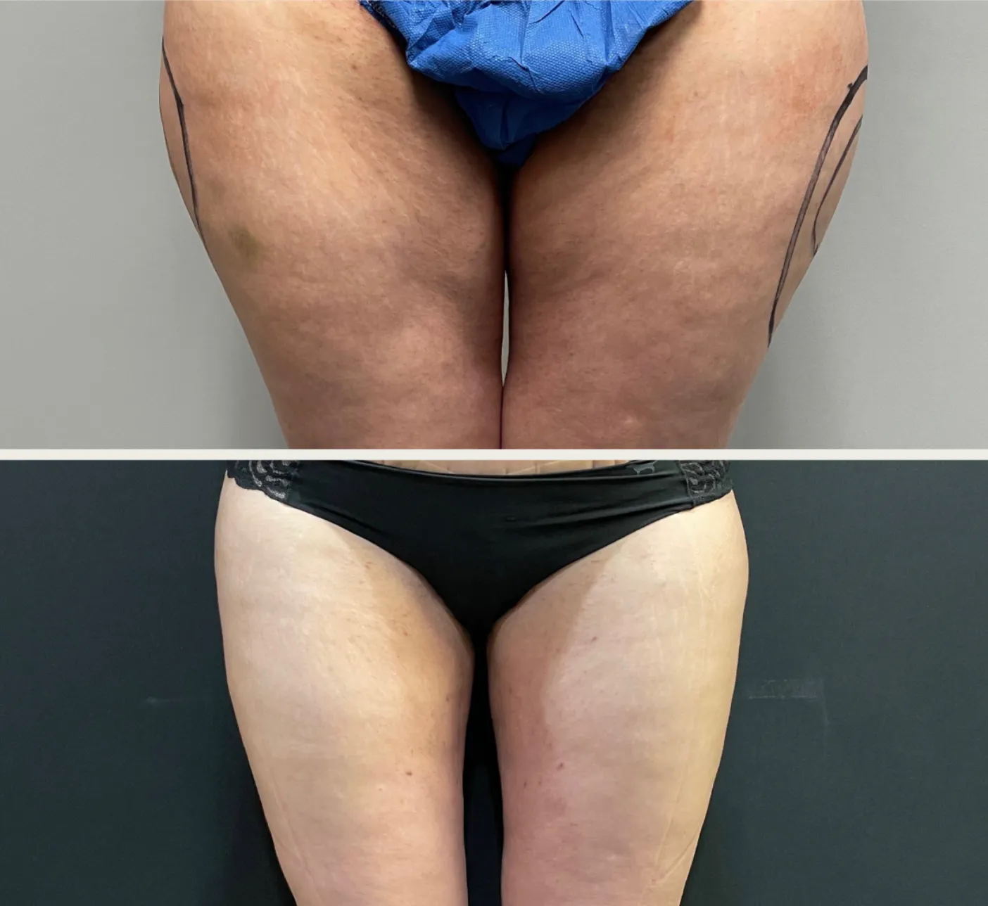 Thighs before & after — case 71