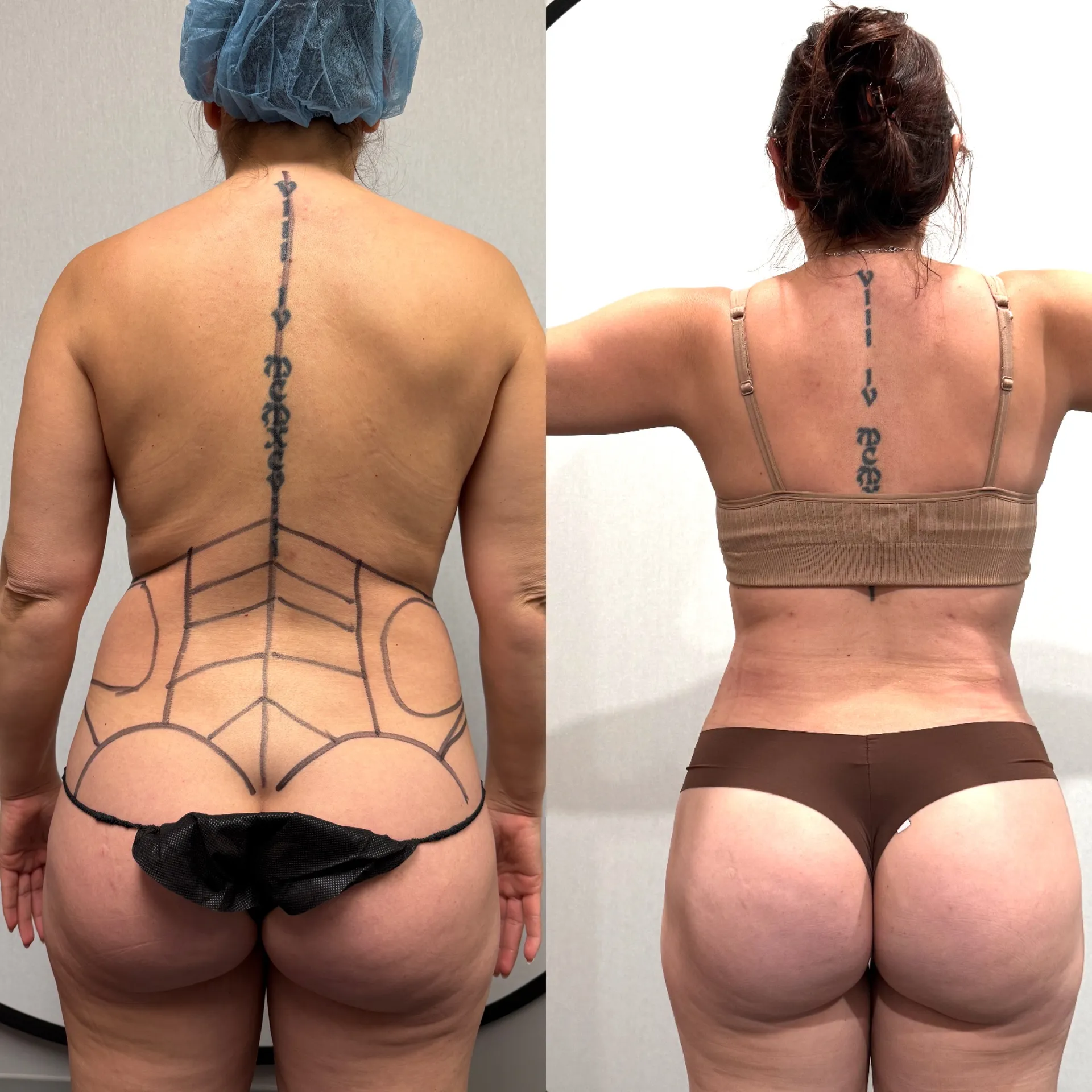 Back before & after — case 19