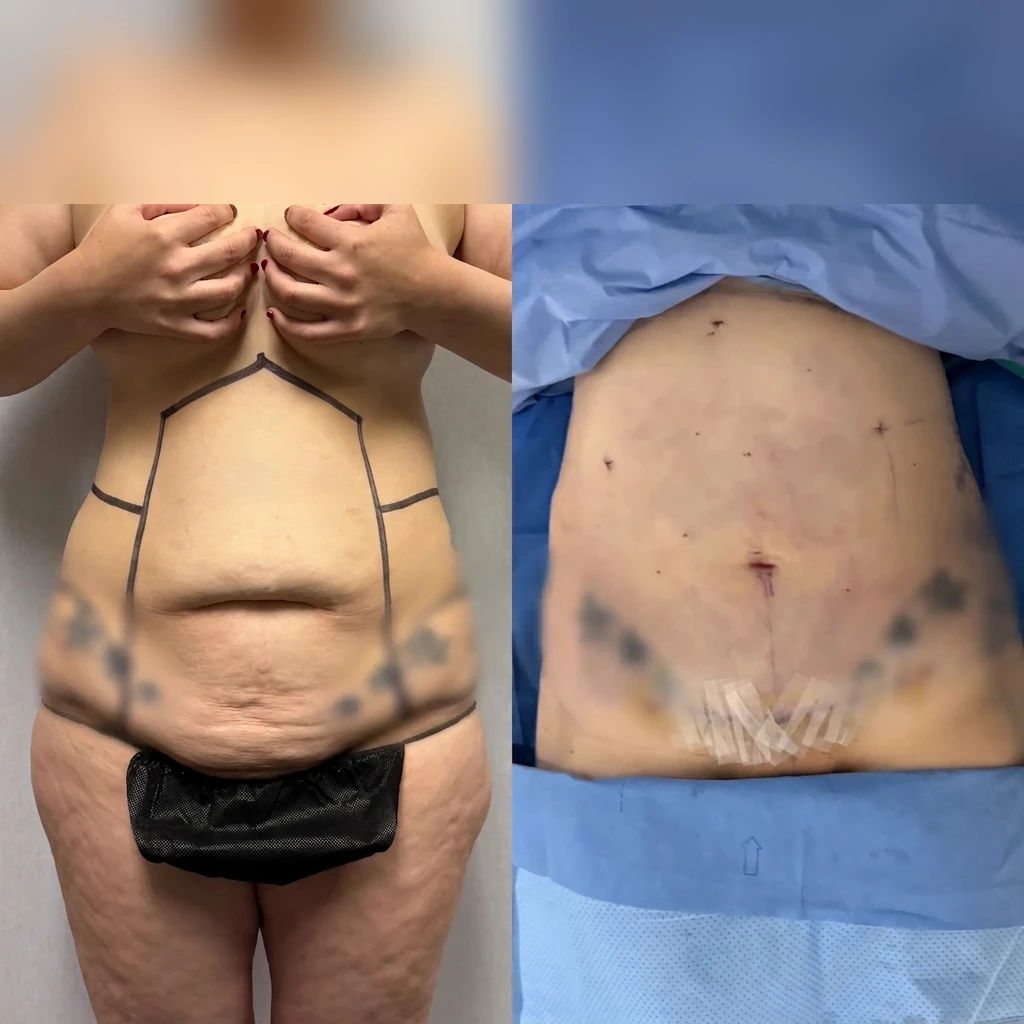 Women — Mini Tummy Tuck