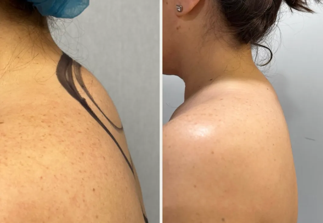 Results before & after — case 21