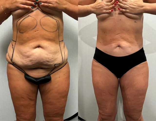 Mini Tummy Tuck before & after — case 51