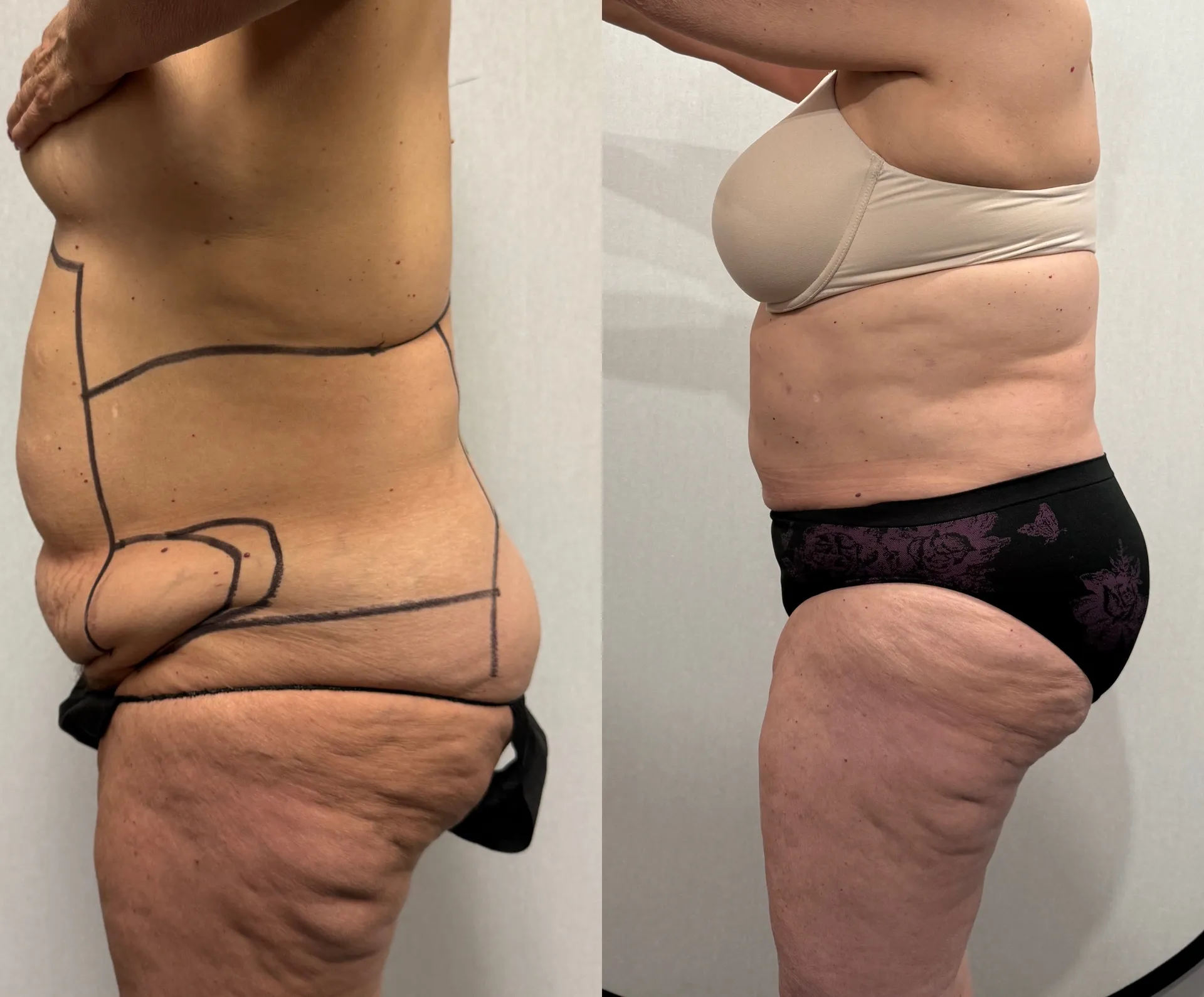 Sides & Flanks before & after — case 85