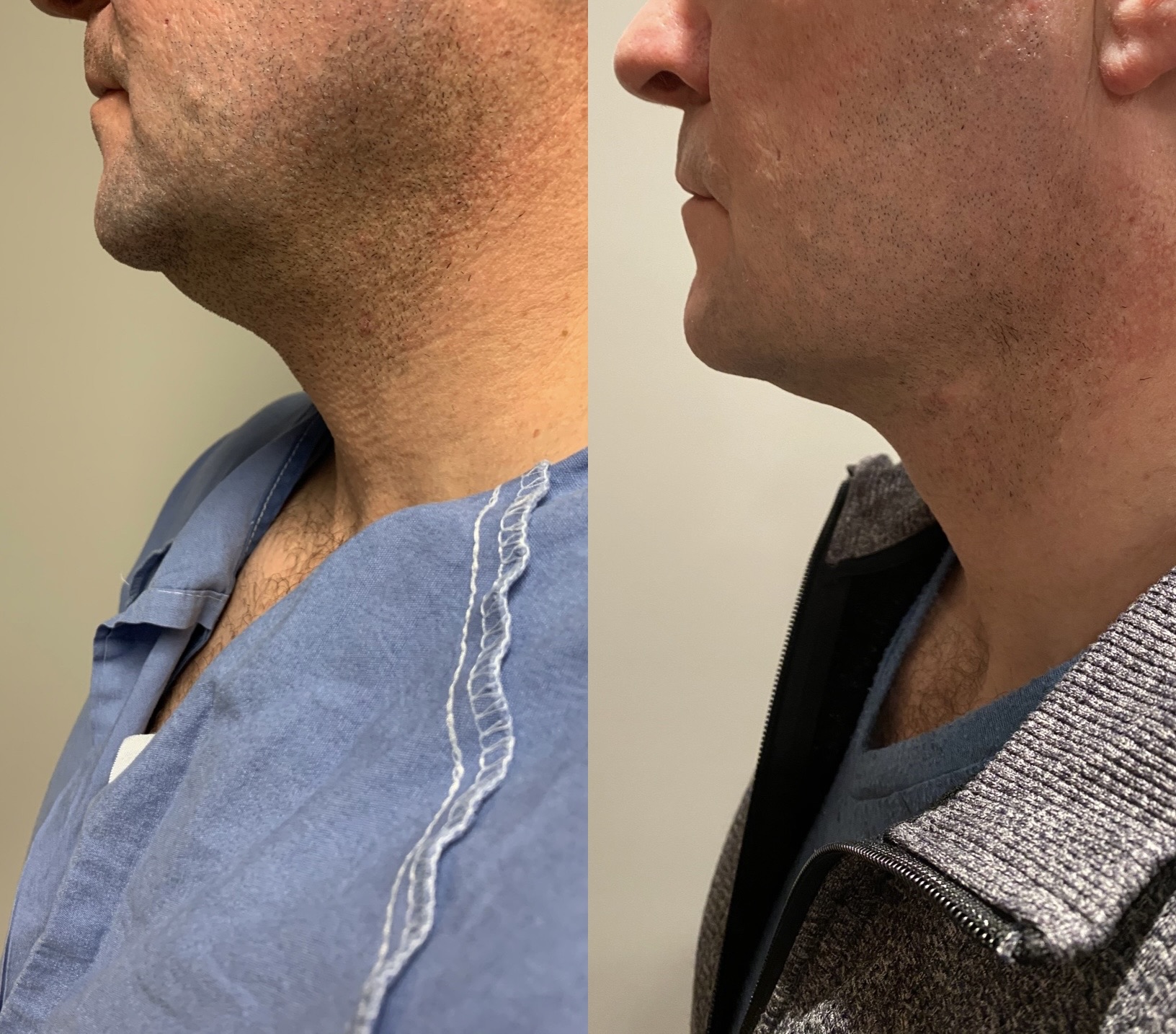 Men — Chin & Neck