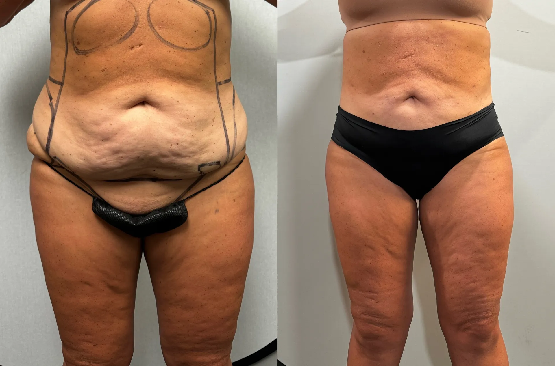 Abdomen before & after — case 26